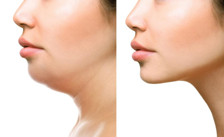You are currently viewing How to Reach Your Aesthetic Goals with KYBELLA