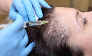 Read more about the article How PRP Therapy Can Natural Restore Your Hair and Skin