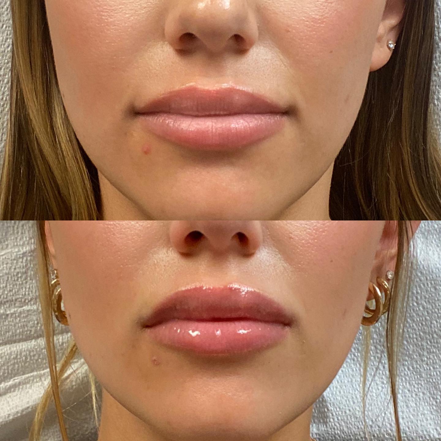 Before & After Lip Filler