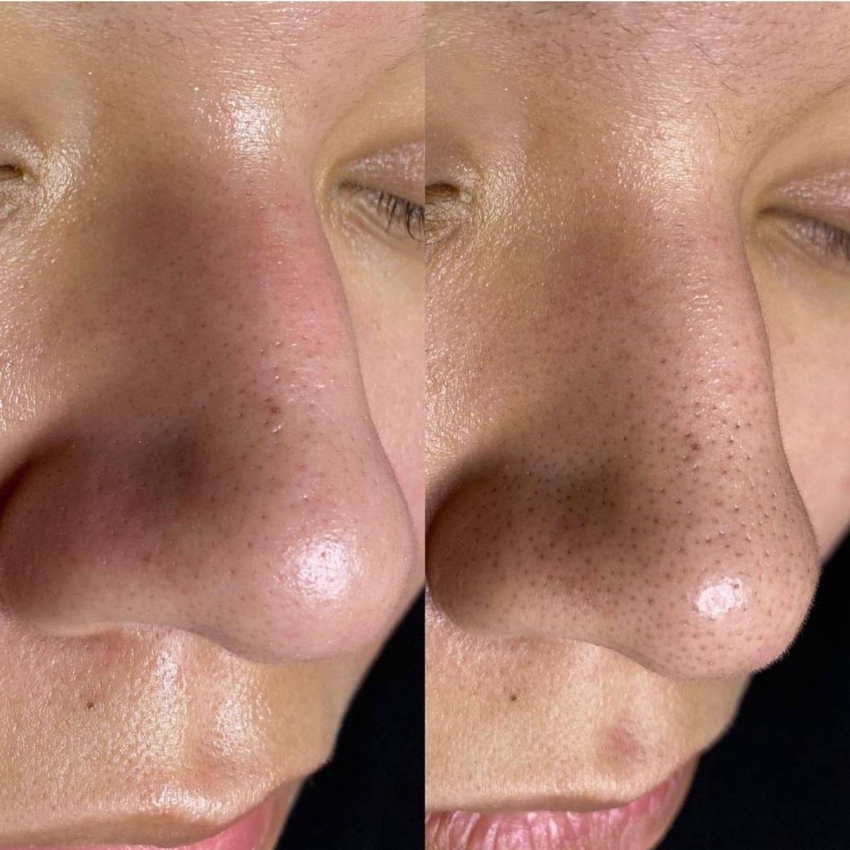 Read more about the article ​​How to Choose the Right Facial Rejuvenation Procedure