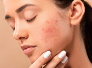 Read more about the article 3 Stress Acne Treatments to Clear Up Your Breakouts