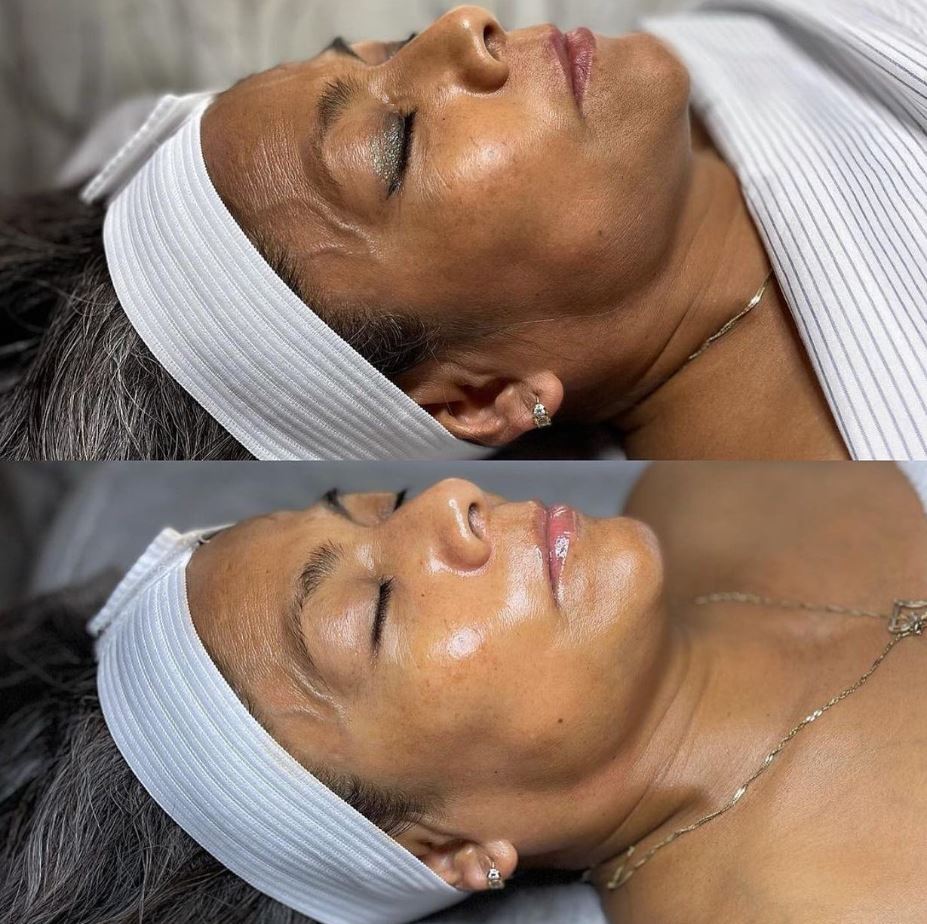 A before and after comparison of a person's face undergoing dermaplaning