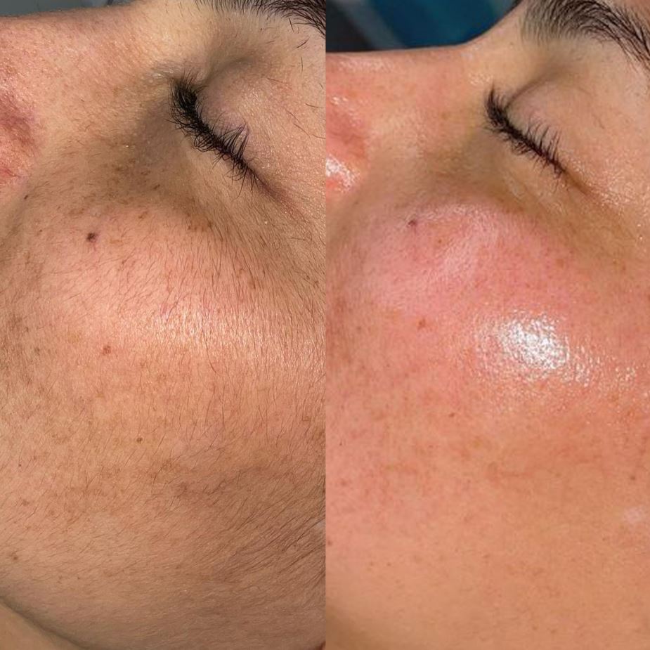 A before and after image of a close-up view of a cheek undergoing dermaplaning, with the left side showing the skin pre-treatment and the right side showing the skin post-treatment, appearing smoother and clearer