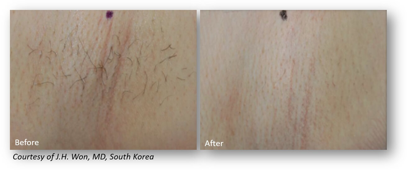 Won Hair Removal Underarm (1)