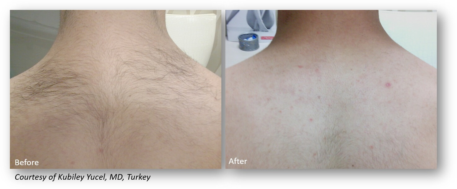 Yucel Hair Removal Back (1)