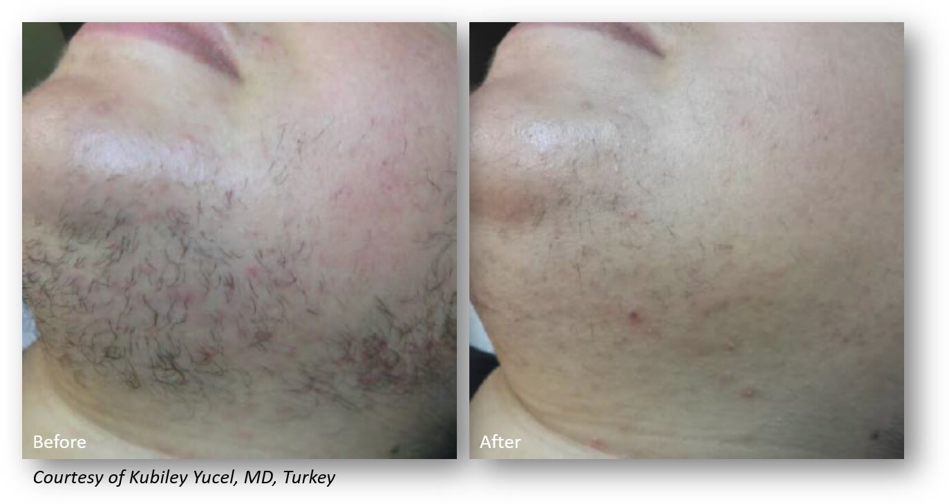 Yucel Hair Removal Face (1)