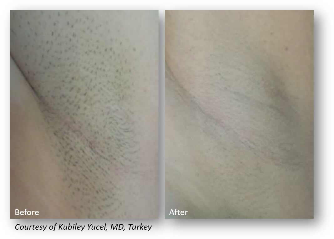 Yucel Hair Removal Underarm (1)