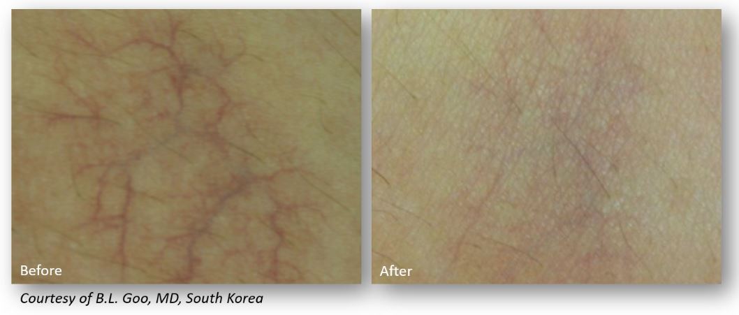 vein removal 4