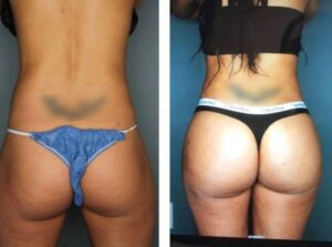 Read more about the article Get Fuller, Curvier Buttocks with Nonsurgical BBL in Pepper Pike, Ohio