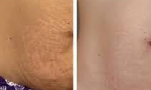 Before and after comparison of skin texture showing improvement in the appearance of stretch marks. The left side displays the skin with visible stretch marks labeled "Before," while the right side shows smoother skin with reduced stretch marks labeled "After." This image highlights the effectiveness of a skin treatment or product aimed at reducing the visibility of stretch marks, promoting skin health, and enhancing overall skin appearance. Ideal for individuals seeking solutions for skin concerns related to stretch marks.