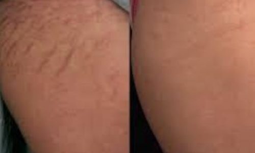 Before and after image showing the treatment of stretch marks on the skin. The left side displays prominent stretch marks, while the right side shows significantly reduced visibility of the marks, indicating effective treatment. This visual comparison highlights the potential improvements in skin appearance following various dermatological procedures. The image serves as a reference for those seeking information on stretch mark treatments and their effectiveness.