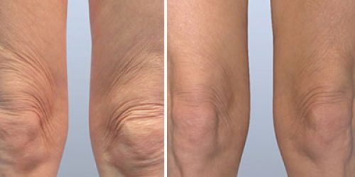 Before and after comparison of a knee showing skin texture changes. The left side displays a wrinkled and sagging appearance, indicating signs of aging or skin laxity. The right side shows a smoother, firmer knee, suggesting improvement through cosmetic procedures or treatments. This image highlights the impact of skin rejuvenation techniques on knee aesthetics, appealing to individuals considering similar enhancements.