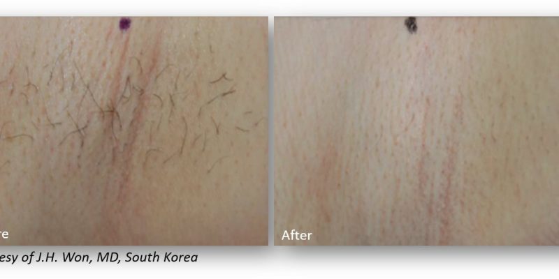 Before and after images showing skin treatment results. The left side displays skin with visible fine lines and imperfections, while the right side shows smoother, clearer skin after treatment. The images emphasize the effectiveness of skincare solutions available in South Korea, highlighting the improvement in skin texture and appearance. Ideal for those seeking skincare options that enhance skin health and aesthetics.