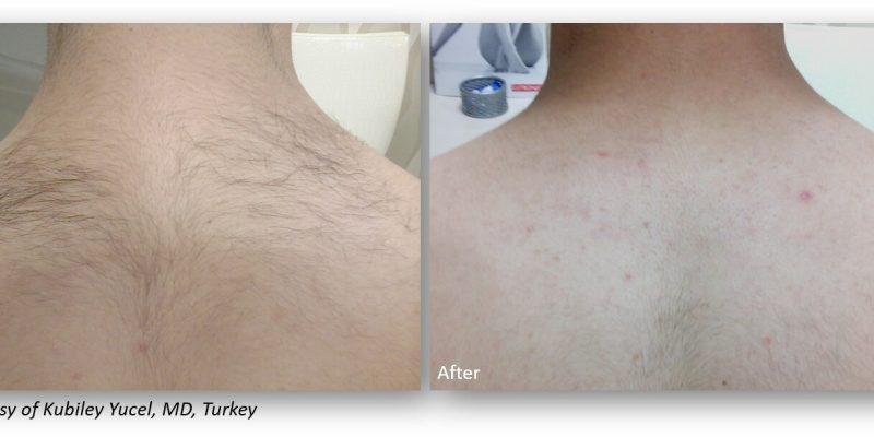 Before-and-after comparison of skin treatment results, showcasing significant improvement in skin texture and appearance. The left side displays uneven skin with visible hair and imperfections, while the right side shows smoother, clearer skin. This image highlights the effectiveness of skin rejuvenation or hair removal treatments, ideal for individuals seeking to enhance their skin's aesthetic quality. Suitable for use in beauty and skincare articles or websites focusing on treatment outcomes.