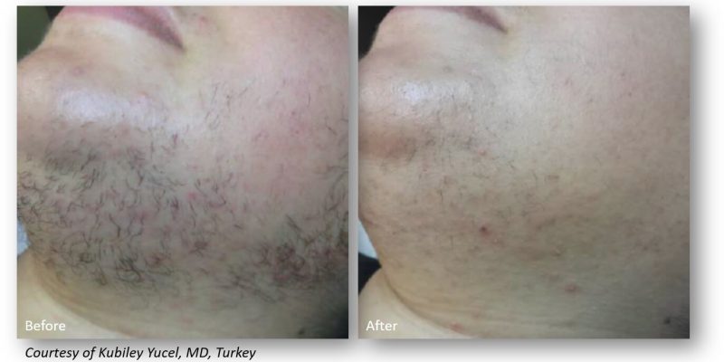 Before and after images showing the results of a facial treatment, highlighting improvements in skin texture and clarity. The left side displays the skin's condition prior to treatment, with visible blemishes and uneven tone. The right side illustrates the post-treatment results, demonstrating smoother skin and reduced imperfections. This visual comparison emphasizes the effectiveness of the skincare procedure, appealing to individuals seeking skin improvement solutions. Ideal for use in articles or websites focusing on skincare treatments, facial rejuvenation, or dermatology services.