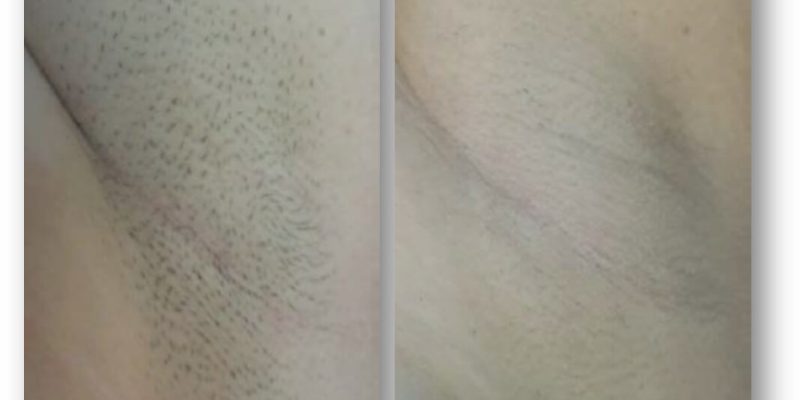 Before and after images showcasing the results of a hair removal treatment. The left side displays skin with visible hair follicles, while the right side shows smooth, hair-free skin post-treatment. This visual comparison highlights the effectiveness of the procedure in reducing hair visibility, emphasizing improved skin texture and appearance. Ideal for individuals seeking hair removal solutions.