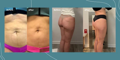 Before and after transformation photos showcasing body contouring results. The left image displays a flat stomach labeled "After," while the middle image shows the back view labeled "Before," highlighting noticeable changes in body shape. The right image presents another "After" view, emphasizing improved body contours. These images illustrate the effectiveness of body transformation techniques, focusing on waist and buttock areas. Ideal for individuals seeking fitness inspiration or body enhancement solutions.
