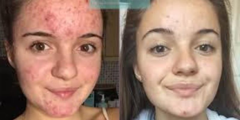 Before and after image showcasing a young woman with acne on the left and clearer skin on the right. The left side displays visible acne and blemishes, while the right side shows significant improvement in skin clarity and texture. The background suggests a home environment. This image highlights the effectiveness of skincare treatments or routines aimed at reducing acne and enhancing skin health. Ideal for discussions on skincare, acne treatment, and personal care journeys.