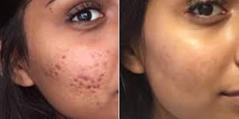 Before-and-after comparison of a woman's face showing the effects of acne treatment. The left side displays visible acne scars and blemishes, while the right side shows clear, smooth skin with significantly reduced imperfections. This image highlights the improvement in skin texture and appearance following effective skincare or treatment, emphasizing the potential for positive results in acne management.