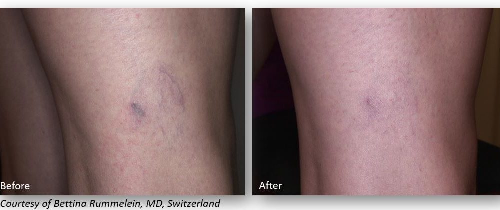 vein removal 2