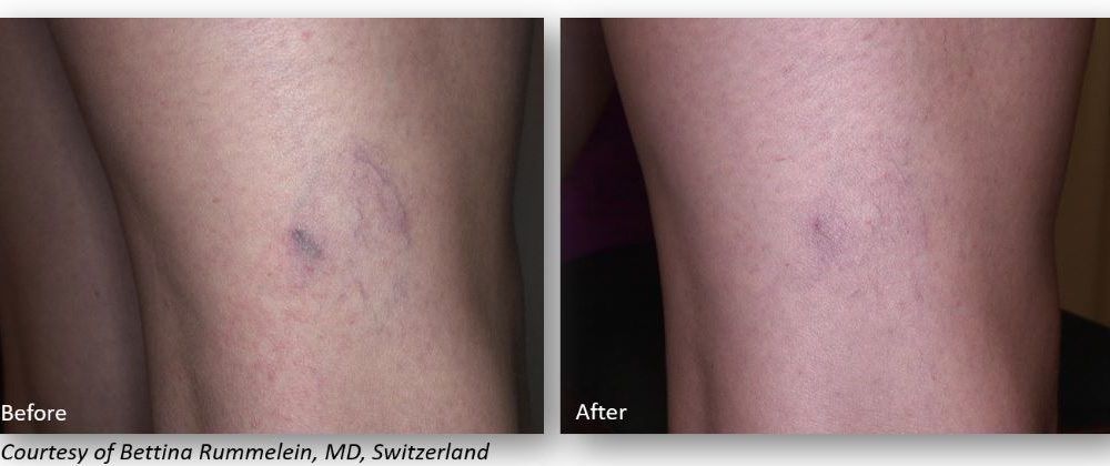Before and after images showcasing the results of a medical treatment for leg scarring. The left side displays a visible scar on the thigh, while the right side shows a smooth, improved appearance post-treatment. This transformation highlights advancements in scar reduction techniques. Ideal for individuals seeking information on effective scar treatment options.