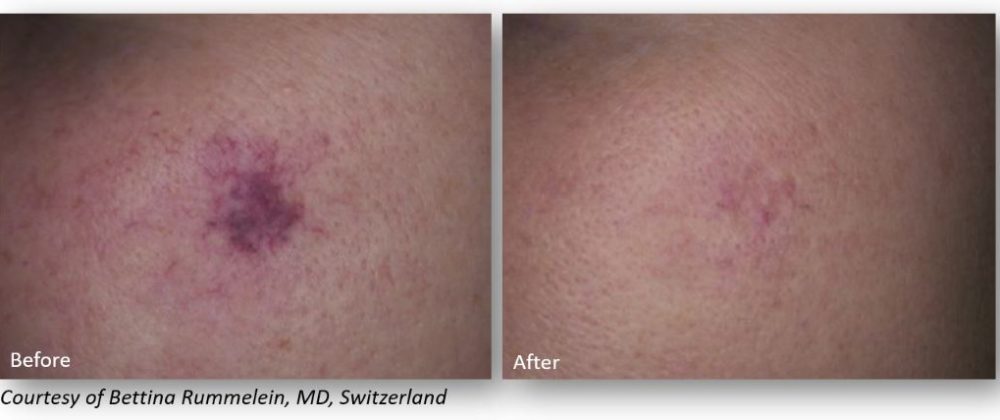 Before and after images showcasing skin treatment results. The left side displays skin with visible blemishes and redness, while the right side shows improved skin texture and clarity after treatment. This comparison highlights the effectiveness of dermatological procedures in reducing acne scars and promoting healthier skin. Ideal for individuals seeking solutions for skin imperfections.