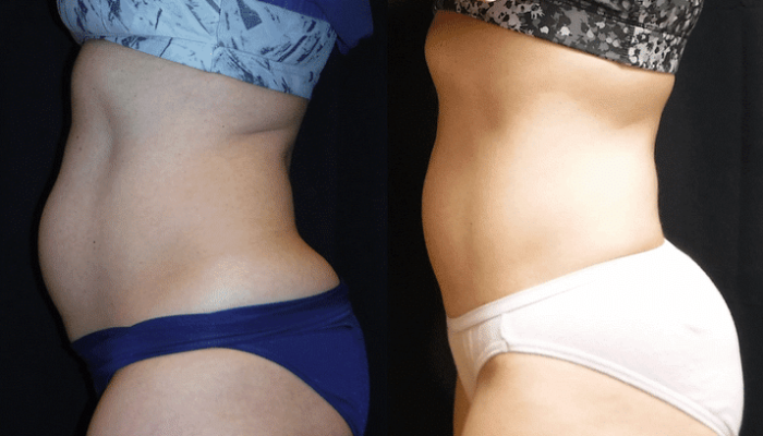 Before and after image showcasing body contouring results, featuring two side profiles of a woman's midsection. The left side displays a softer waistline, while the right side highlights a more toned and sculpted appearance. Both subjects are wearing athletic underwear, emphasizing changes in body shape. This visual representation illustrates the effectiveness of body transformation treatments offered by Dr. T. Evolve. The image aims to provide potential clients with a clear understanding of the results achievable through professional body contouring services.