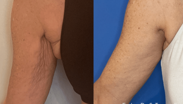Before and after image showcasing the results of a body contouring treatment on the arms. The left side displays loose skin and wrinkles, while the right side reveals a smoother, firmer appearance. The background is a solid blue, enhancing the visibility of the skin texture differences. This image illustrates the effectiveness of the treatment in improving skin tone and elasticity, making it relevant for those considering body sculpting options.