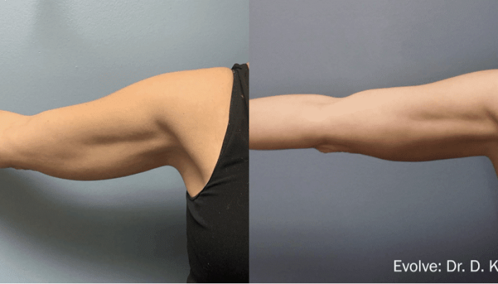 Image showing two arms positioned differently: one is bent at the elbow, displaying the bicep, while the other is fully extended, highlighting the tricep. Both arms are toned and muscular, set against a neutral background. This visual illustrates the contrast between flexed and relaxed arm positions, emphasizing muscle definition and strength. Ideal for fitness and health content, this image can be used to discuss strength training techniques, arm workouts, or anatomy.
